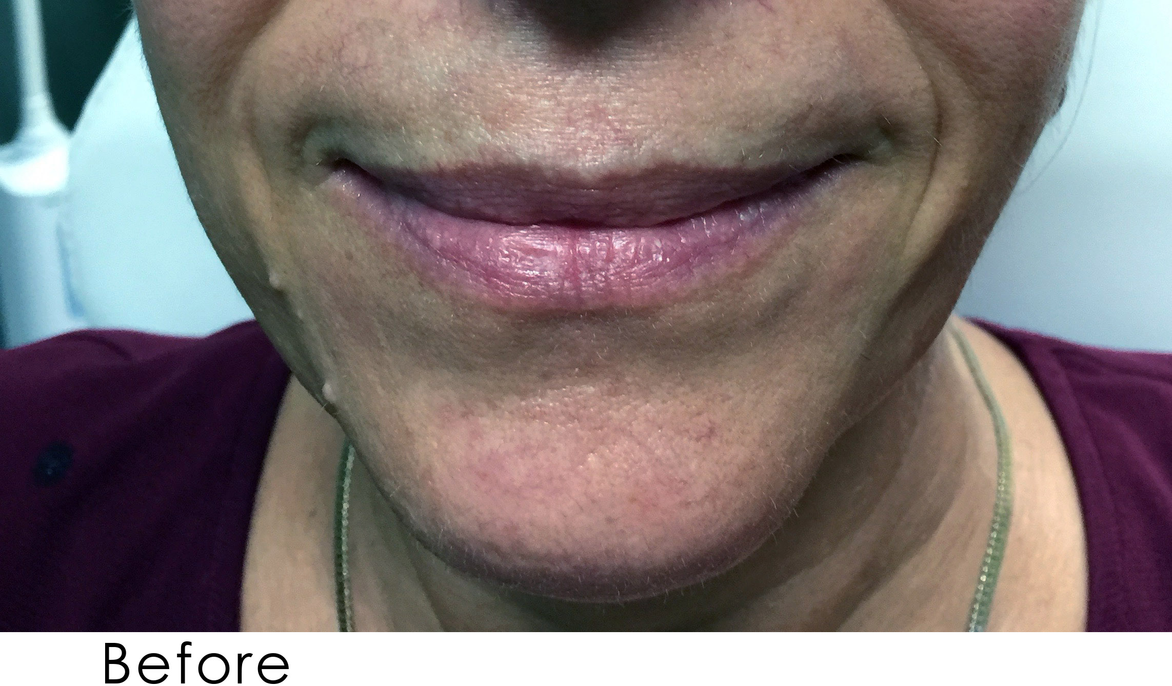 PRP Before